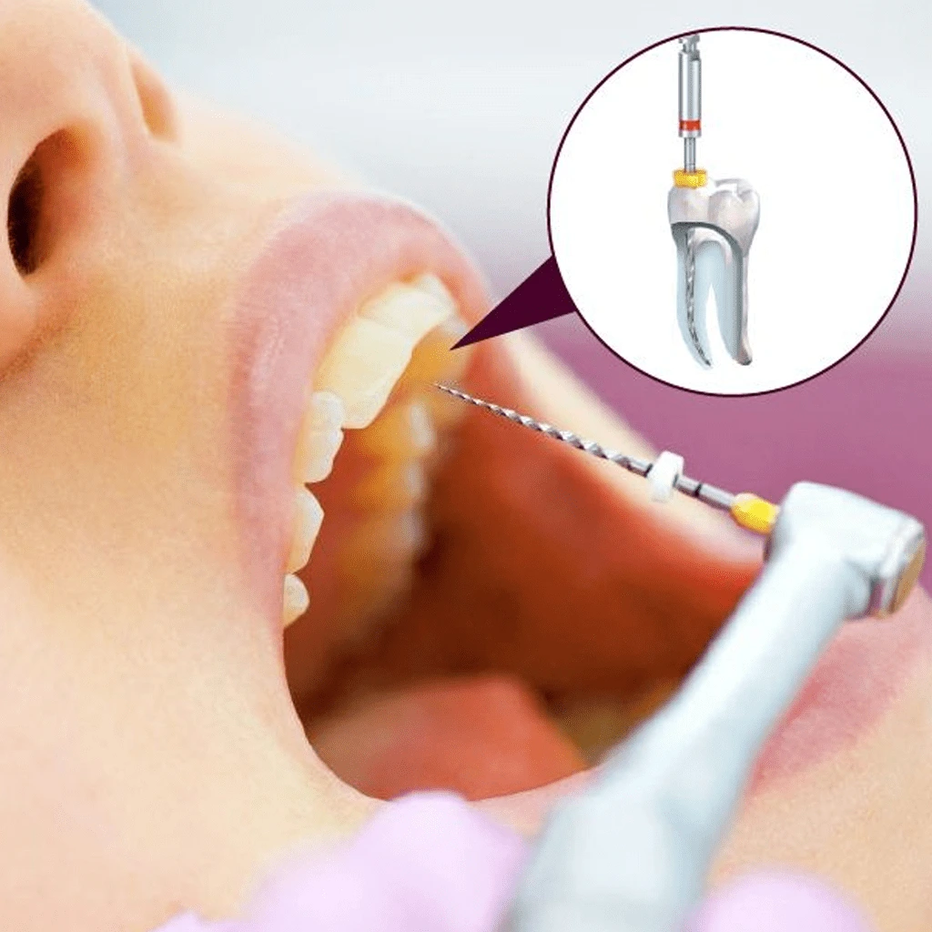 Advanced Root Canal