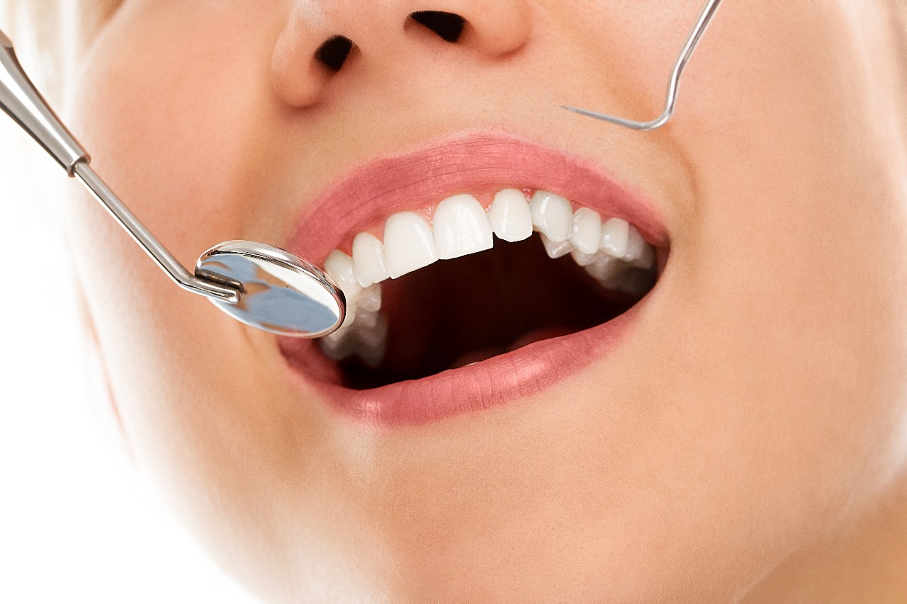 Tooth Coloured Fillings