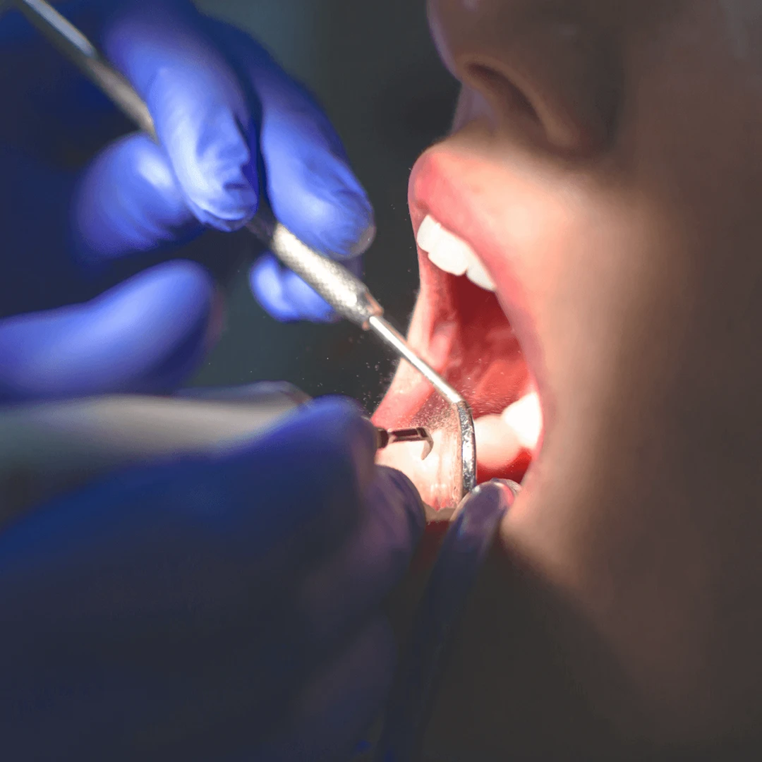 Benefits of Endodontic Surgeries