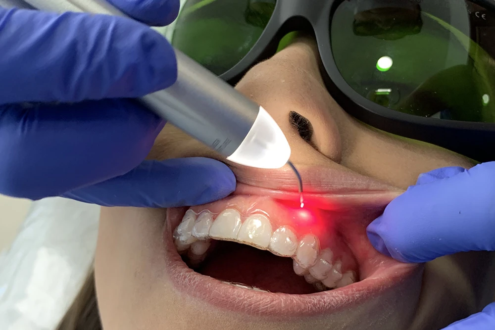 Advanced laser dentistry procedure