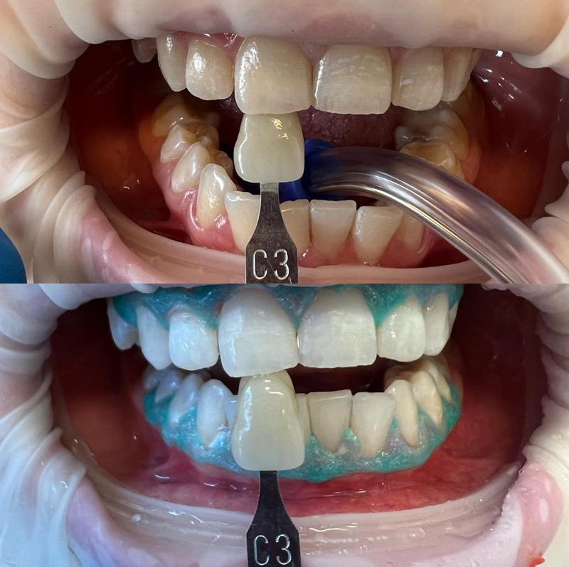 Dental Whitening Treatment